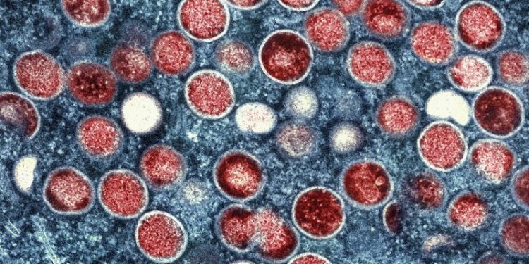 Sweden confirms first case of mpox